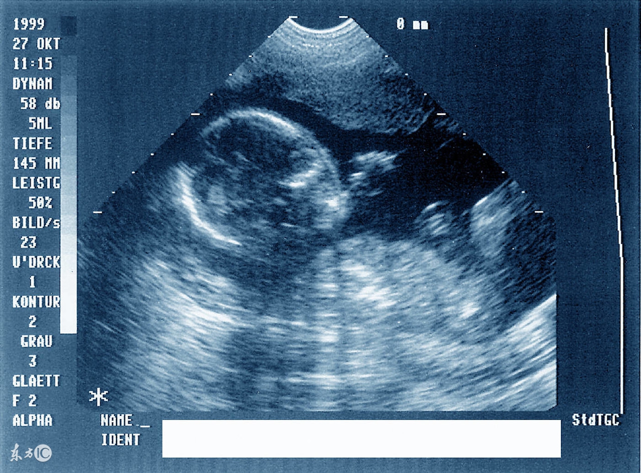 孕期做彩超的目的与最佳时间