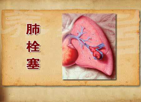 肺栓塞抢救过来还有危险吗,肺栓塞患者家属注意事项