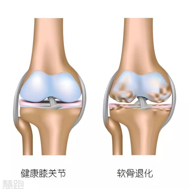 吃软骨补软骨素么,膝盖疼痛吃软骨素有效果吗