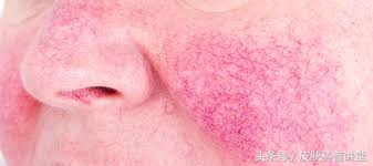 酒渣鼻玫瑰痤疮是怎么引起的,玫瑰痤疮会变成酒渣鼻吗