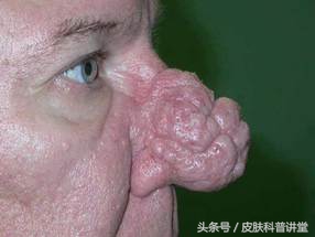 酒渣鼻玫瑰座疮用什么药膏,酒渣鼻玫瑰痤疮能自愈吗