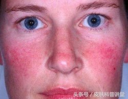 酒渣鼻玫瑰痤疮是怎么引起的,玫瑰痤疮会变成酒渣鼻吗