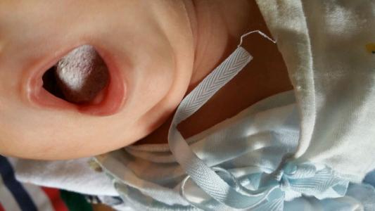 氟康唑胶囊治疗鹅口疮的使用方法,婴儿鹅口疮最快的解决方法