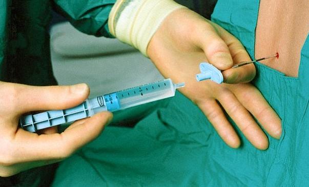 女人顺产侧切缝针为什么不打麻药,产妇侧切缝针后尿拉不出来怎么办