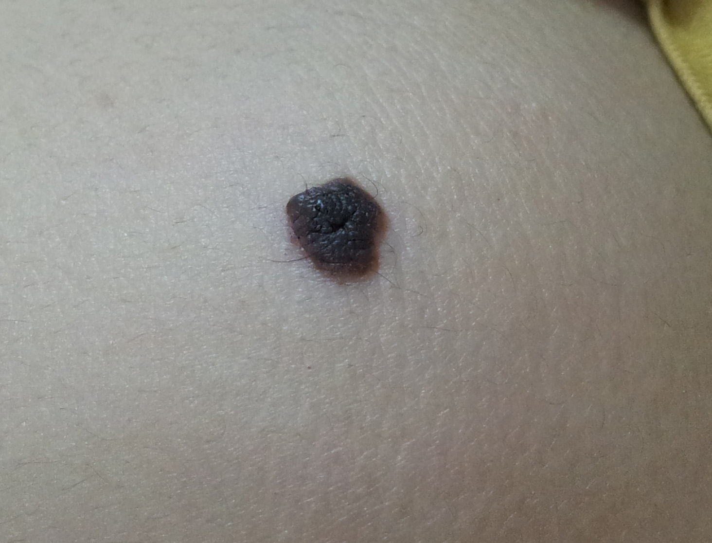 熬夜睡觉都睡得好会不会长痣,熬夜长痣的原因