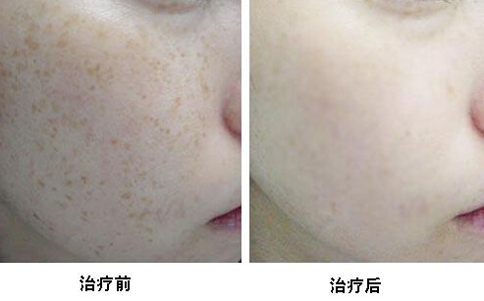 皮秒治疗的仪器叫什么,皮秒激光案例