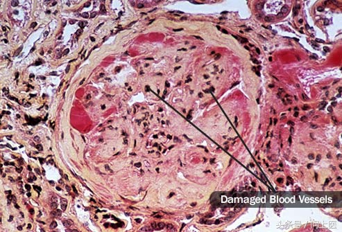 尿液哪个指标可以看出肾功能异常,尿液异常原因有哪些