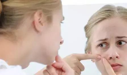 祛痘痘的正确护肤方法,长痘祛痘用什么方法最有效