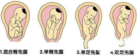 胎儿头和臀哪个先露出最危险,胎儿头朝上分娩时会朝下吗