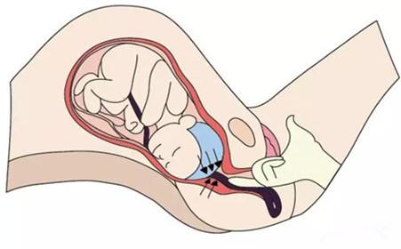 胎儿顶先露和臀先露是什么意思,孕妇脐带先露有什么危害