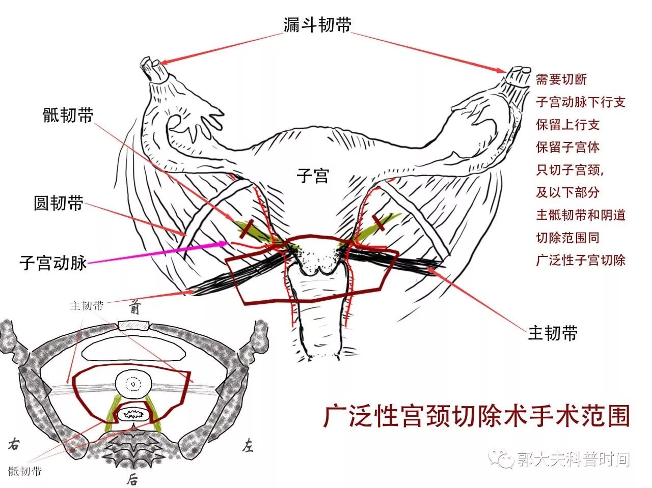 同样是子宫切除，切多一点，切少一点，区别是很大的！