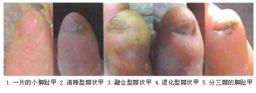 小脚趾头指甲分两瓣,如果你的小脚趾有两瓣趾甲