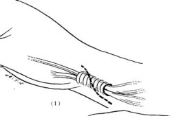 手指腱鞘炎怎么治,膏药能治腱鞘炎吗