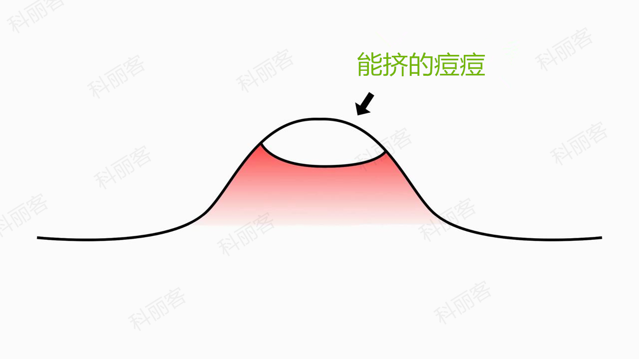 痘痘到底能不能治愈,痘痘到底能不能挤