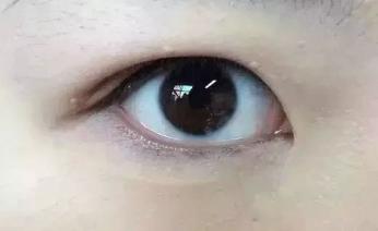 如何不做手术让内双眼皮成为外双,刚做的双眼皮如何才能变得自然