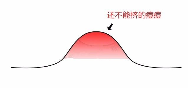 挤完痘痘后皮肤护理视频,挤完痘痘修复视频