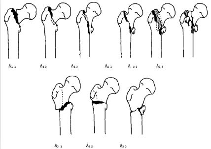 粗隆间骨折做pfna,pfna手术好处