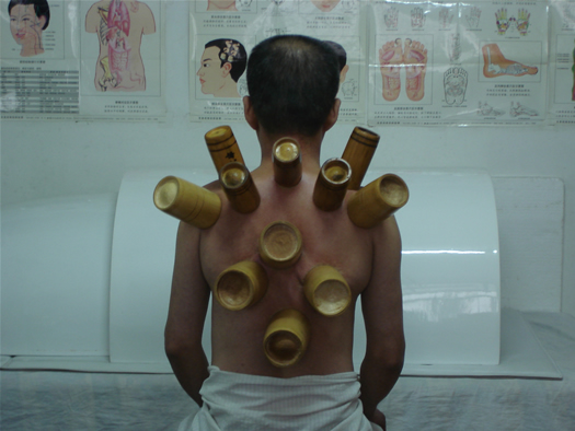 中医拔罐疗法的临床应用,中医拔罐疗法为什么是安全的