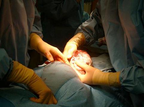 实拍胎儿剖腹产过程，“捧在手里怕摔了，含在嘴里怕化了”！