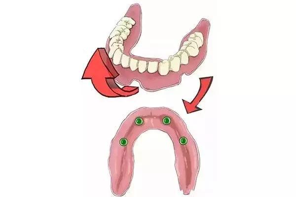 缺牙是种植牙还是烤瓷牙好,烤瓷牙和种植牙哪个保持时间长