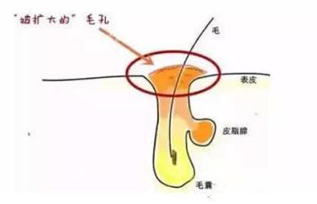 粉刺没有处理好变成硬疙瘩,痘痘粉刺消不掉