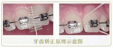 戴牙套托槽松动怎么办,牙套托槽丢了补一个多少钱