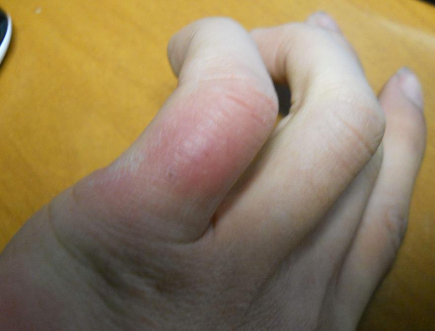 脸部冻伤用什么冻疮膏管用,冻伤可以用冻疮药膏吗