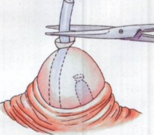 女人上环和男人结扎更建议哪个,男人结扎还是女人上环好一点