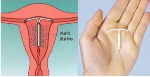 女人上环和男人结扎更建议哪个,男人结扎还是女人上环好一点