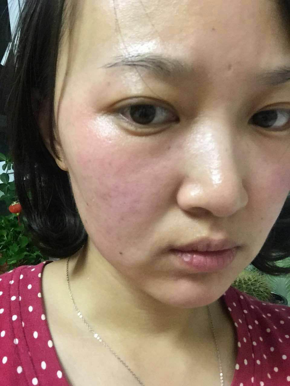 激素脸怎么护肤保湿修复皮肤屏障,激素脸皮炎角质层薄怎么修复