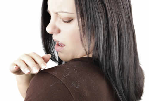 头皮屑引起的脱发怎么办,怎样治疗头皮屑多脱发