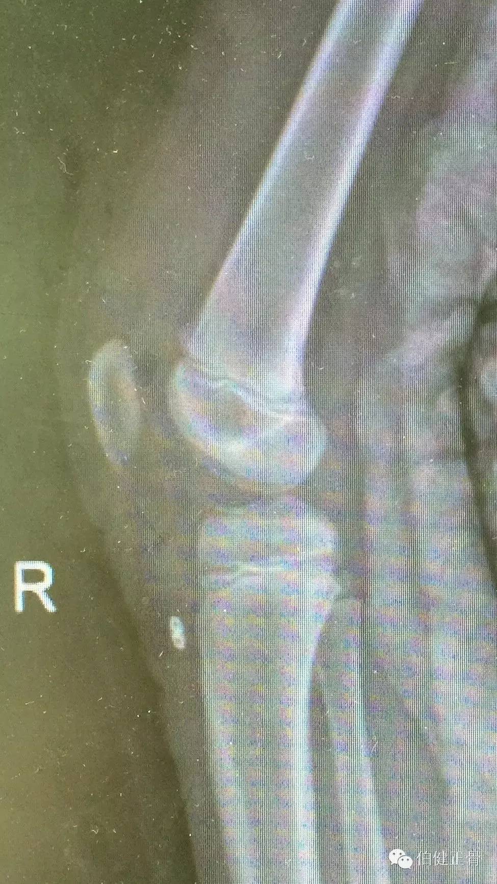 关节内外、经骨骺/不经骨骺单隧道纽扣技术治疗小儿前交叉韧带止点撕脱骨折经验介绍