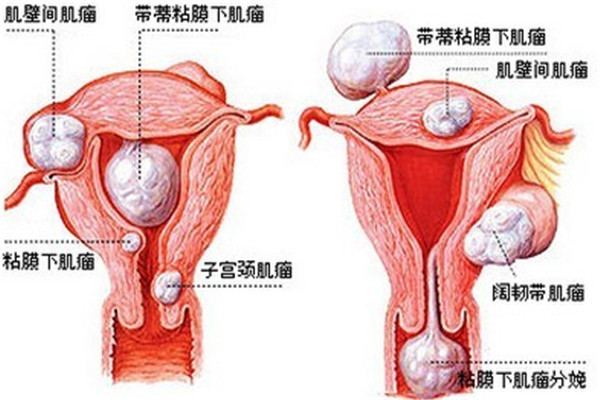 春玲医生上皮细胞肿瘤严重吗,妇科大夫谈怎么预防子宫肌瘤