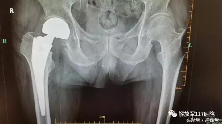 85岁老人关节置换术后存活,70岁老人做关节置换术
