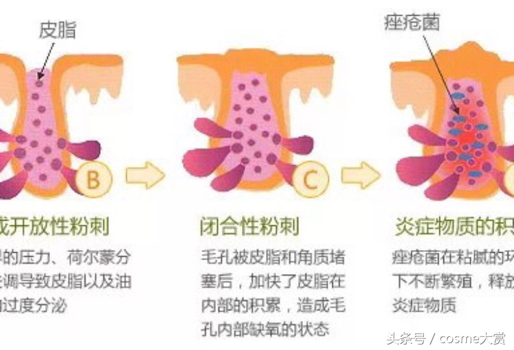 战痘秘方,明星战痘秘诀