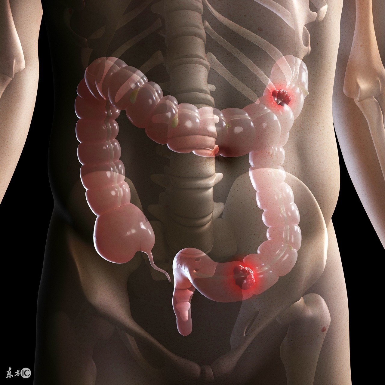 大肠癌早期腹痛在什么位置,肠癌早期有三处疼腹痛