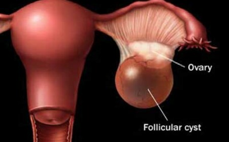 卵巢囊肿你了解多少？
