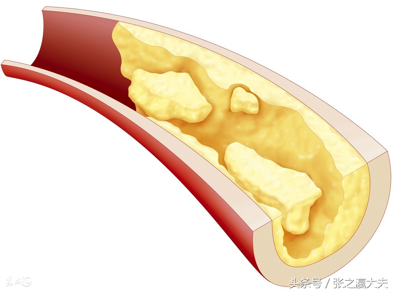 瑞舒伐他汀适合长期吃吗,什么他汀最适合长期服用
