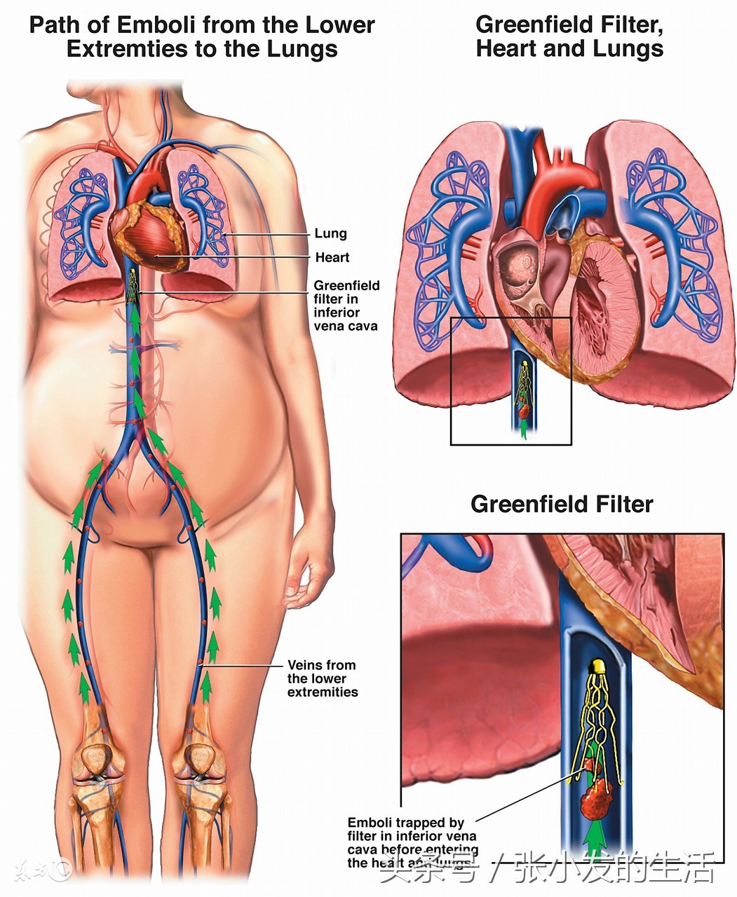急性肺栓塞的表现怎么处理,肺栓塞紧急处理科普视频