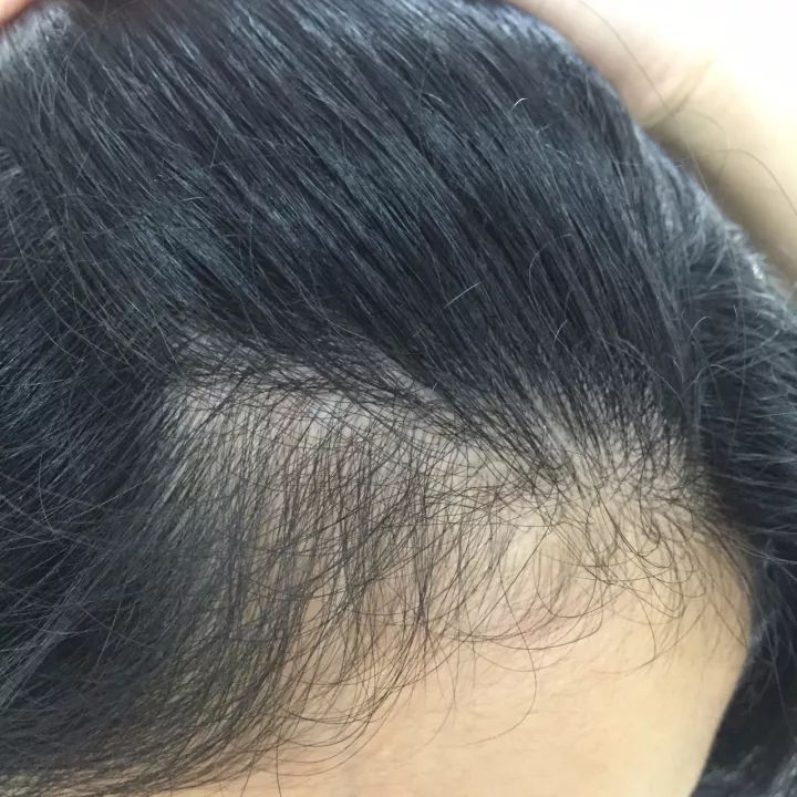 90后的叔叔阿姨，你的头发掉了