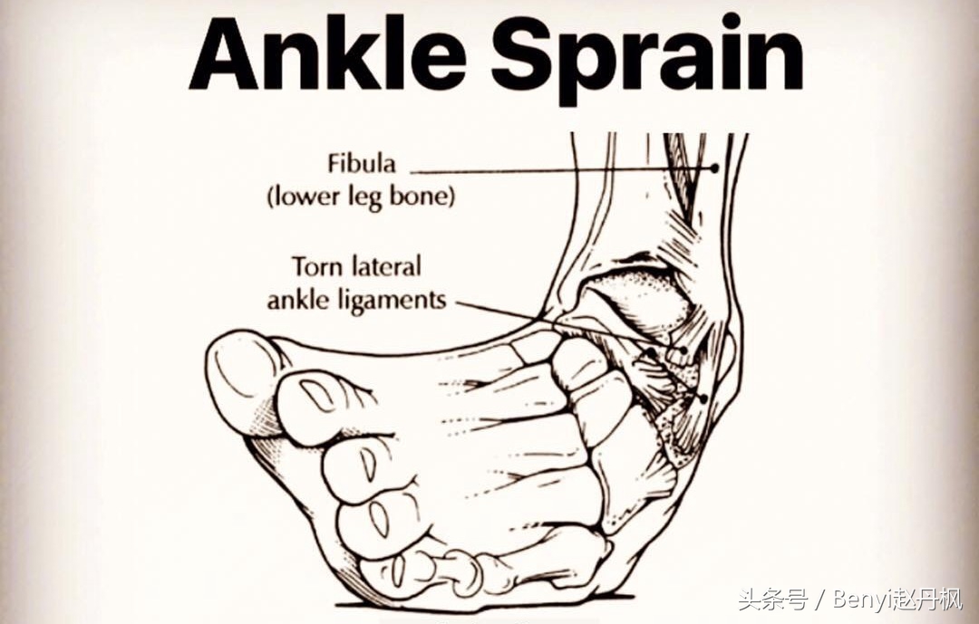 脚踝受伤半年后如何康复训练,脚踝伤病的六个问题