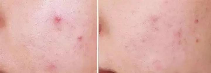 痘痘不长出来也不消怎么办,脸上的痘印持久不消