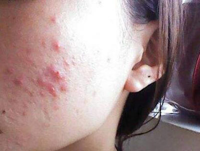 脸上长疮痘什么原因,脸上长个疮里面是硬的怎么办