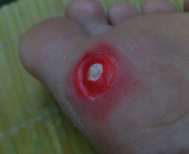 脚上长奇怪的东西是什么,脚上长了一个奇怪东西