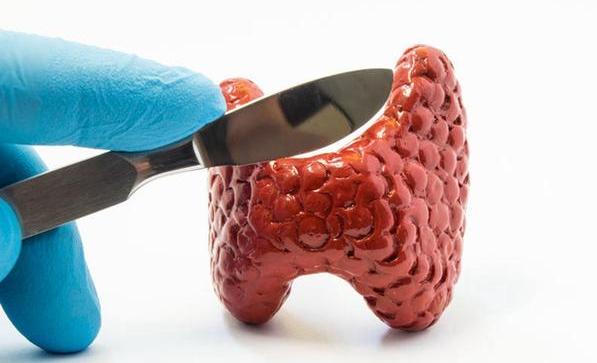 快被癌症家族扫地出门的甲状腺癌：高发却温和10年存活率可达90%