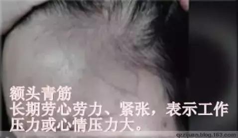 各类青筋的分布和原因,治爆青筋的中药方法