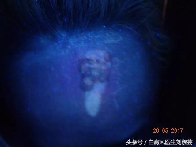 白斑病患者自述,白斑患者图片