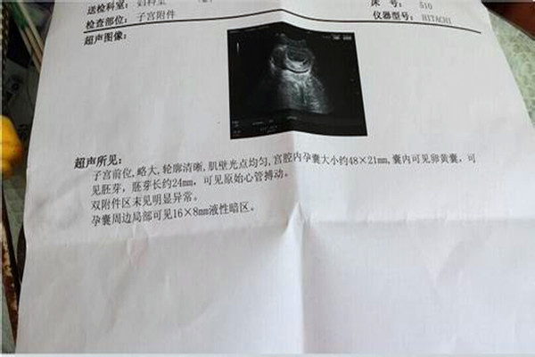 做阴式b超须知,第一次做阴超有没有单子