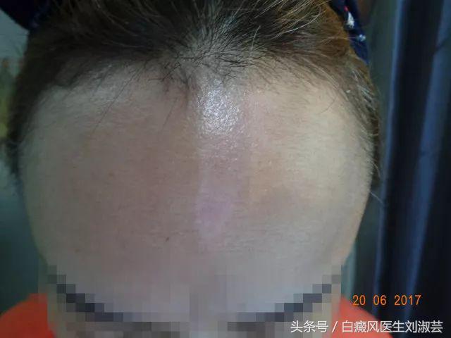 白斑患者的真实生活,白斑患者自述