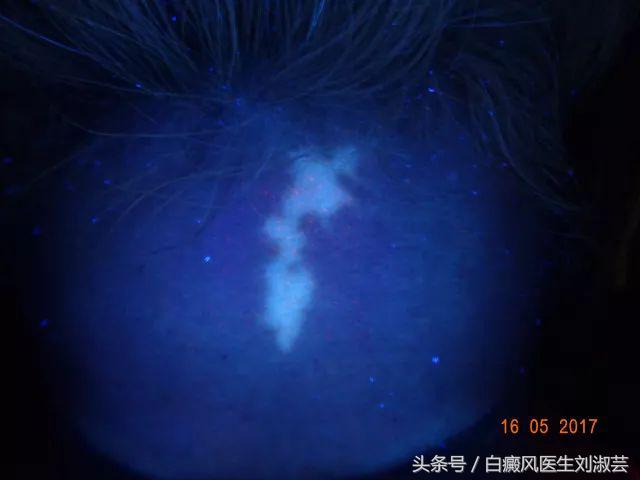 白斑患者的真实生活,白斑患者自述